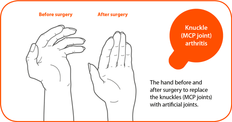 hand surgery Chhabra Hospital