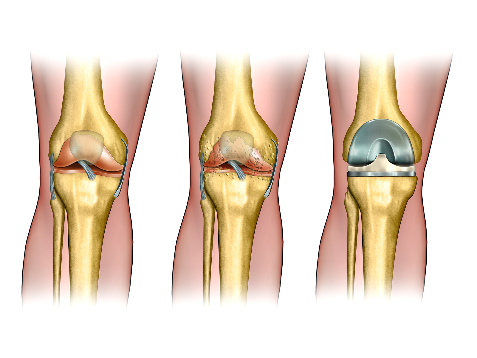 knee replacement Chhabra Hospital